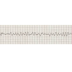 Heart Rhythm Monitor